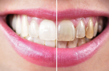 Пятна на зубной эмали – виды и причины появления